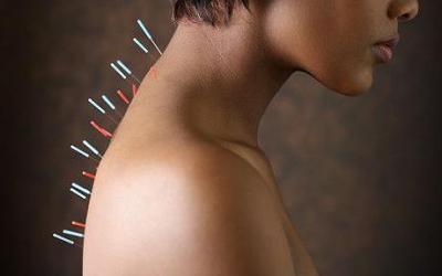 Acupunctura - metoda de tratare a afectiunilor