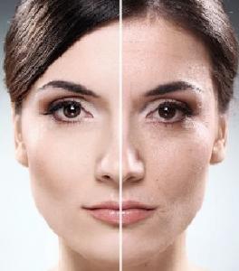 Frumoasa la orice varsta - Rejuvenare celulara faciala cu IPL