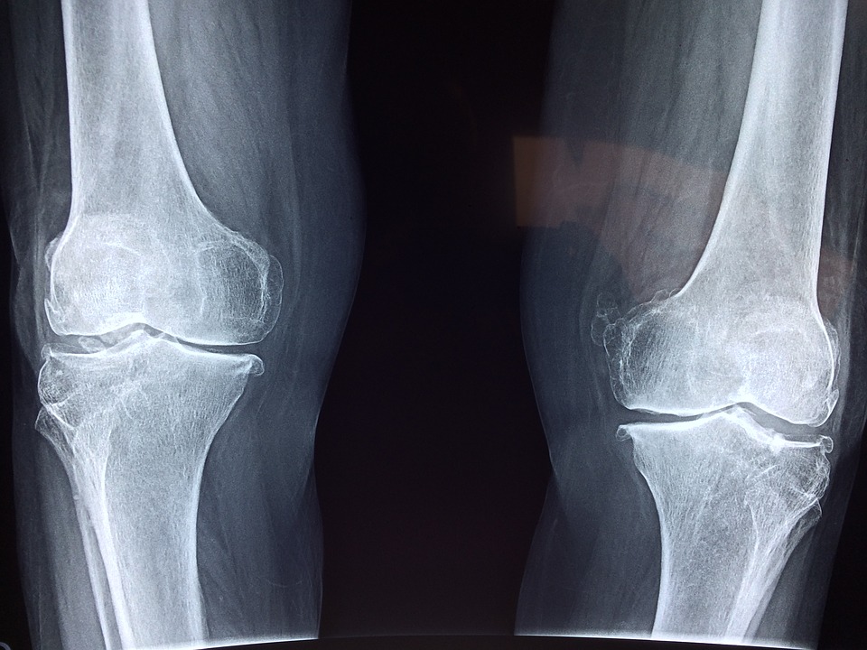 ce alimente provoacă inflamații articulare articulații creak în tratamentul genunchilor