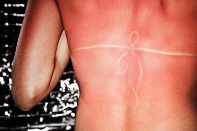 4 tratamente naturiste pentru pielea arsa de soare
