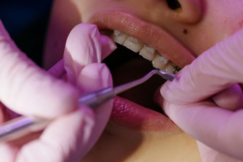 Aparat dentar safir: eleganta, eficienta si confort intr-un singur tratament
