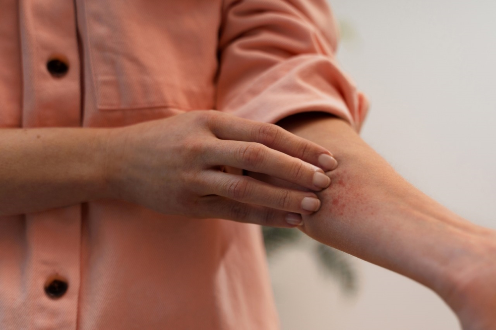 Tratament dermatita atopica: cand pielea are nevoie de sustinere din interior