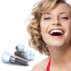 De ce un implant dentar este cea mai buna solutie pentru tine?