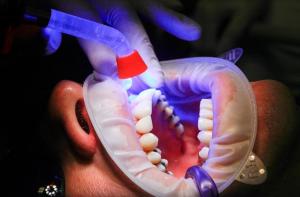 Stomatologia viitorului este stomatologia minim-invaziva, fara durere si cu materiale biocompatibile - Marca Life Dental Spa