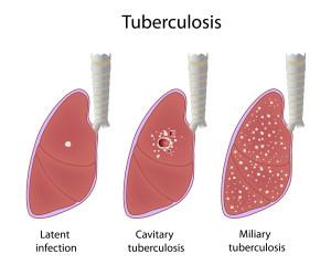 5 lucruri pe care nu trebuie sa le crezi despre tuberculoza
